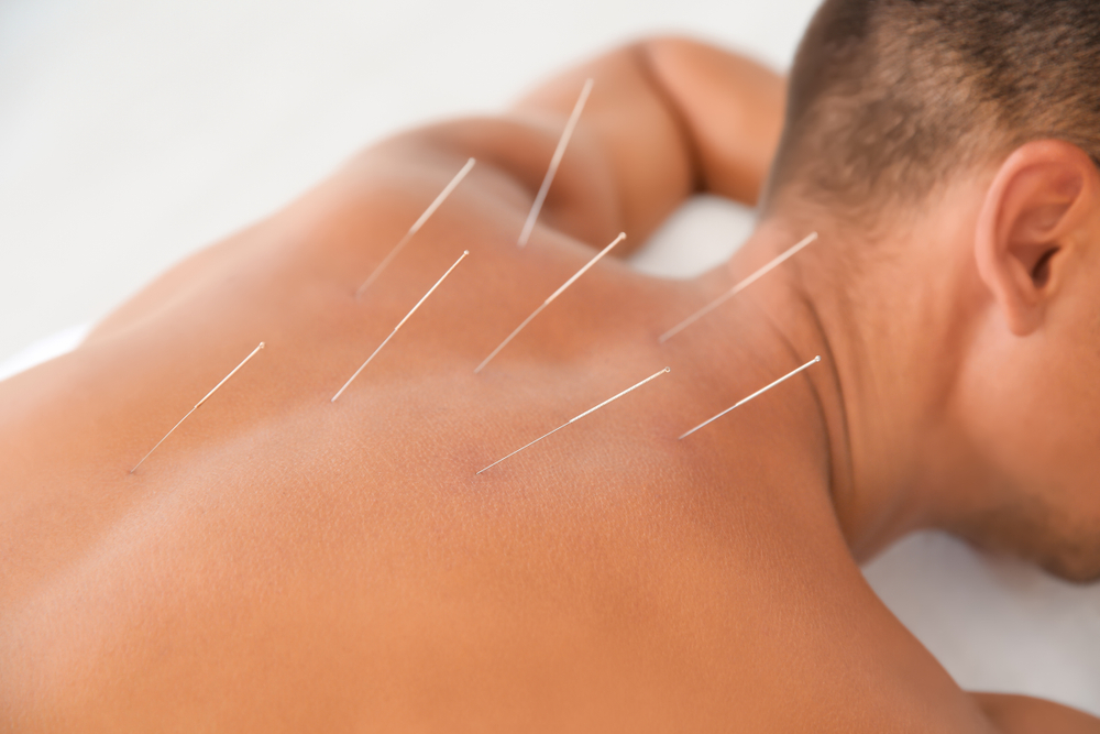 acupuncture needles in man's back