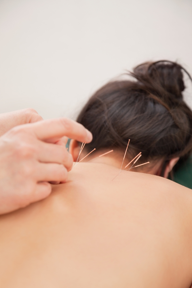 acupuncture on woman's back