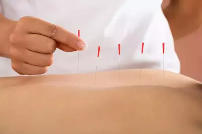 medical acupuncture