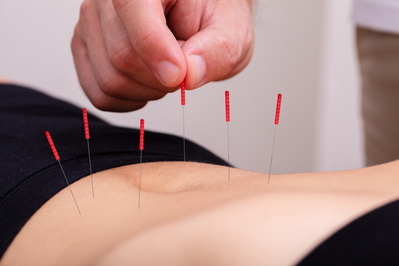 close up of acupuncture on stomach
