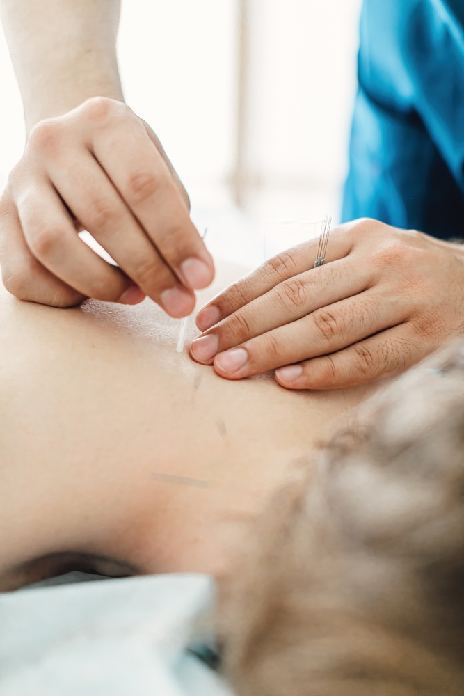 close up of acupuncture on back of shoulders